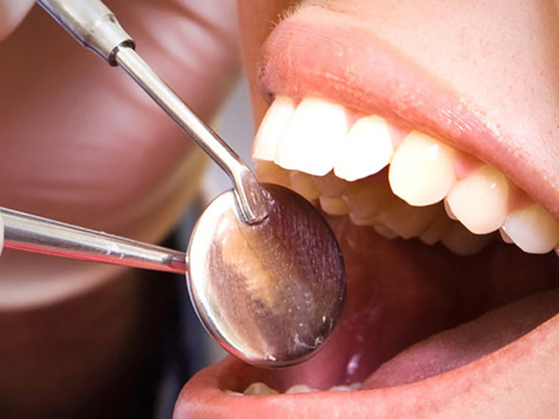 Dental Root Canal Services