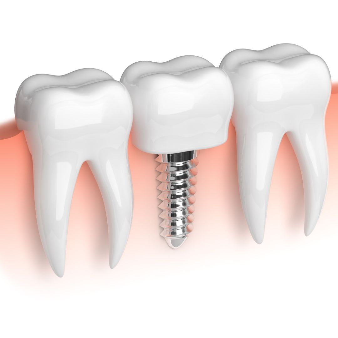 Dental Implant rendering