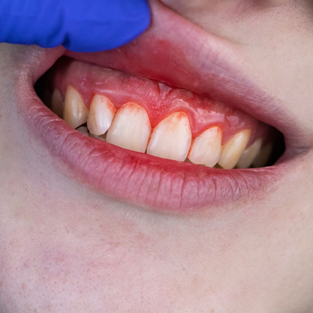 Gums with infection