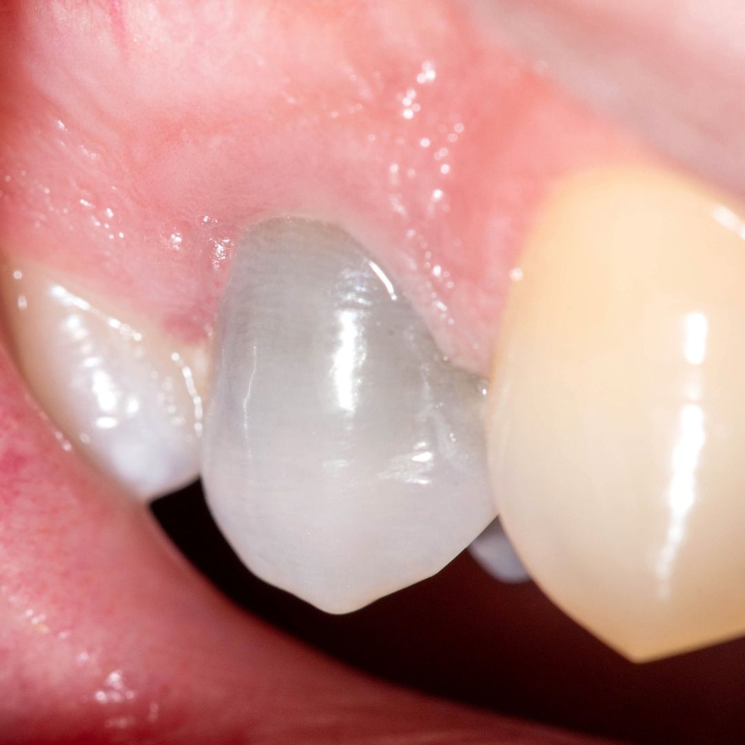 Tooth with yellowish discoloration