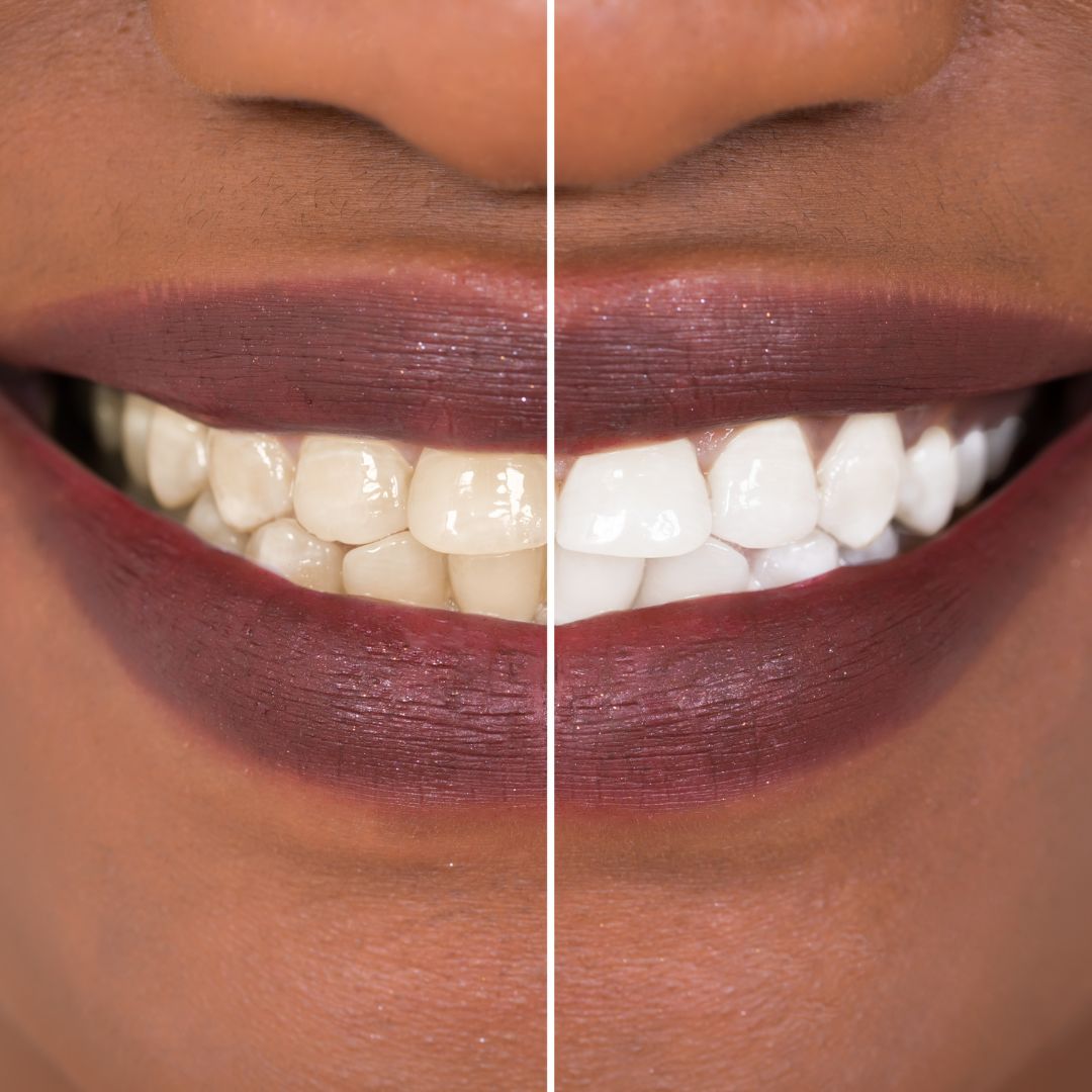 Before and after shot of teeth.